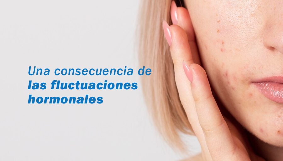 Acné hormonal